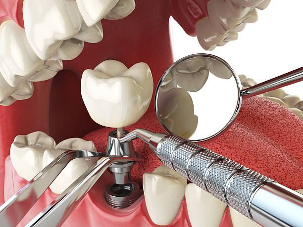 Best Dental Abscess Treatment in Kingsley, MI